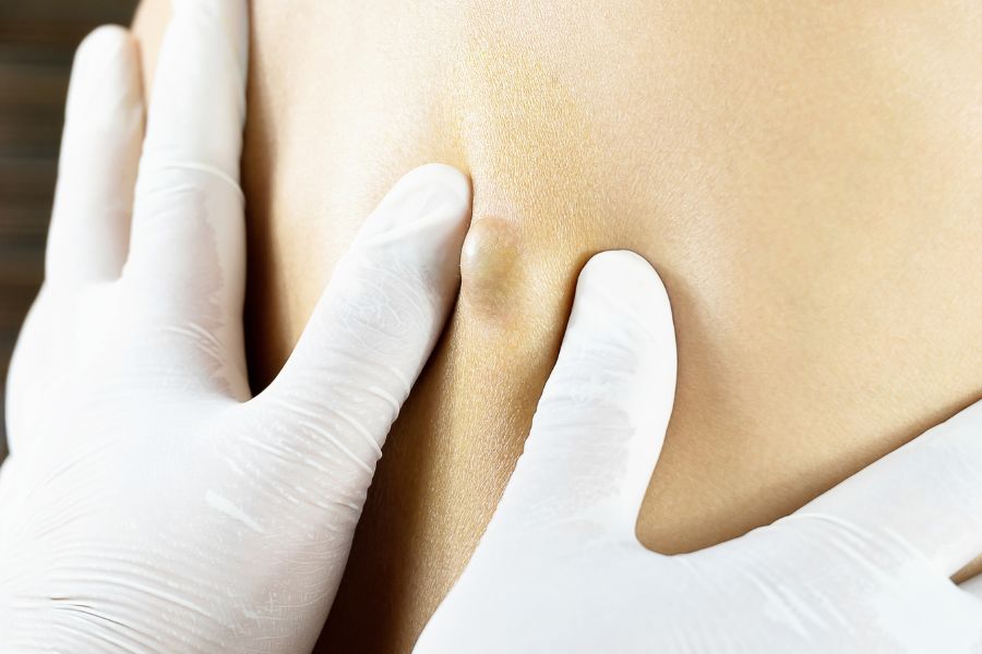 Retirada de cistos e lipomas: Como é feita a pequena cirurgia no consultório